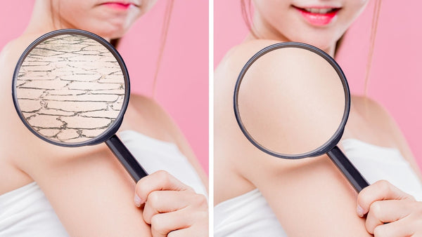 Dry Skin in the Winter - Supplements for Dry Skin
